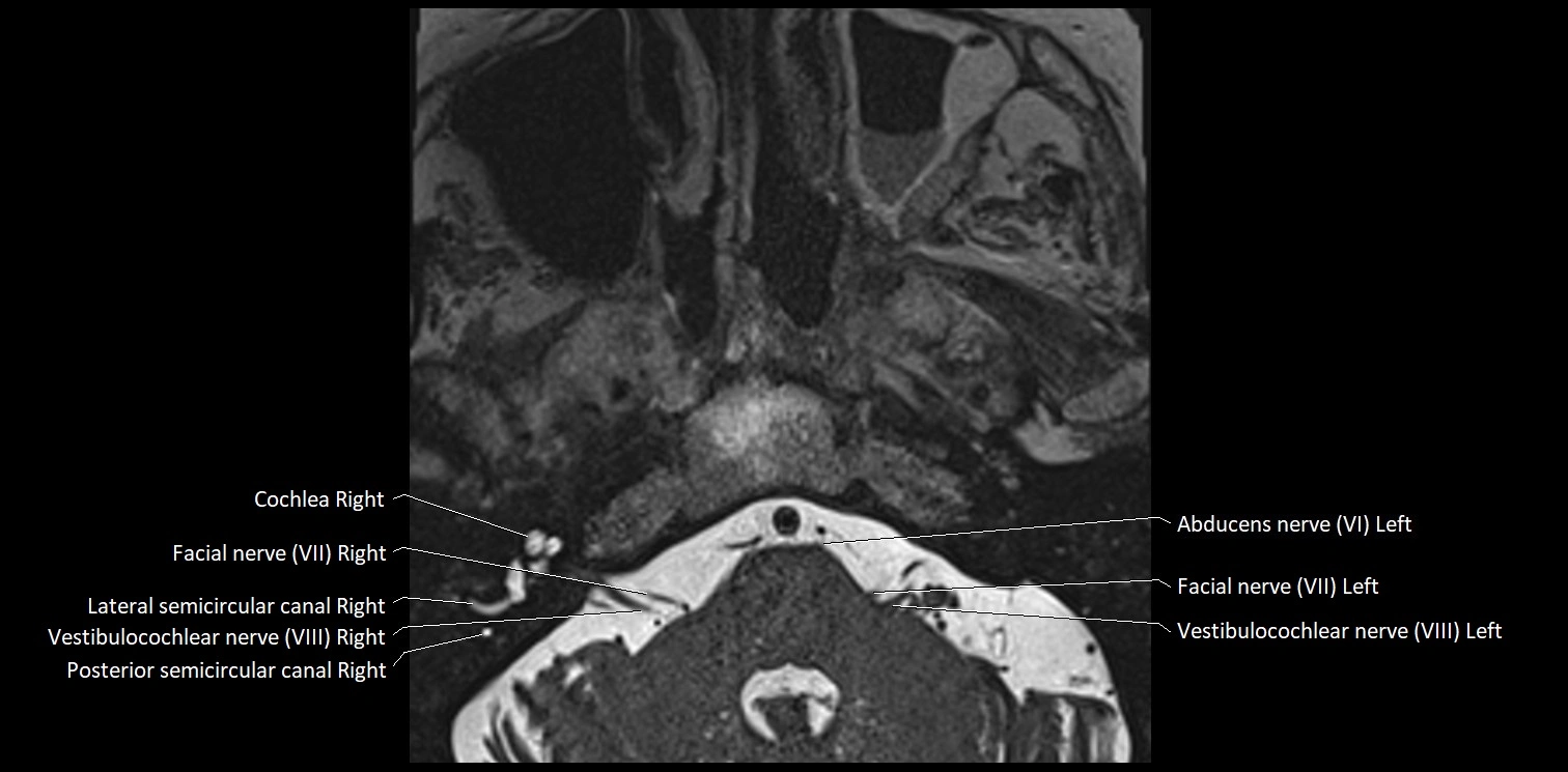 Cranial nerve anatomy axial MRI 3T image 59.webp